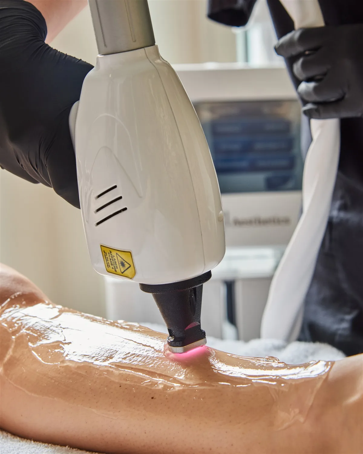 Manipolo laser a diodo durante l'epilazione della gamba, con gel sulla pelle